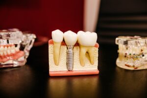 Dentist showing a model of a dental implant to a patient at a consultation table.